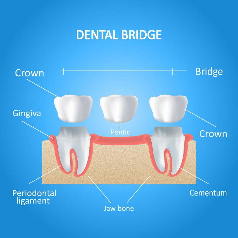 Dental Bridge1