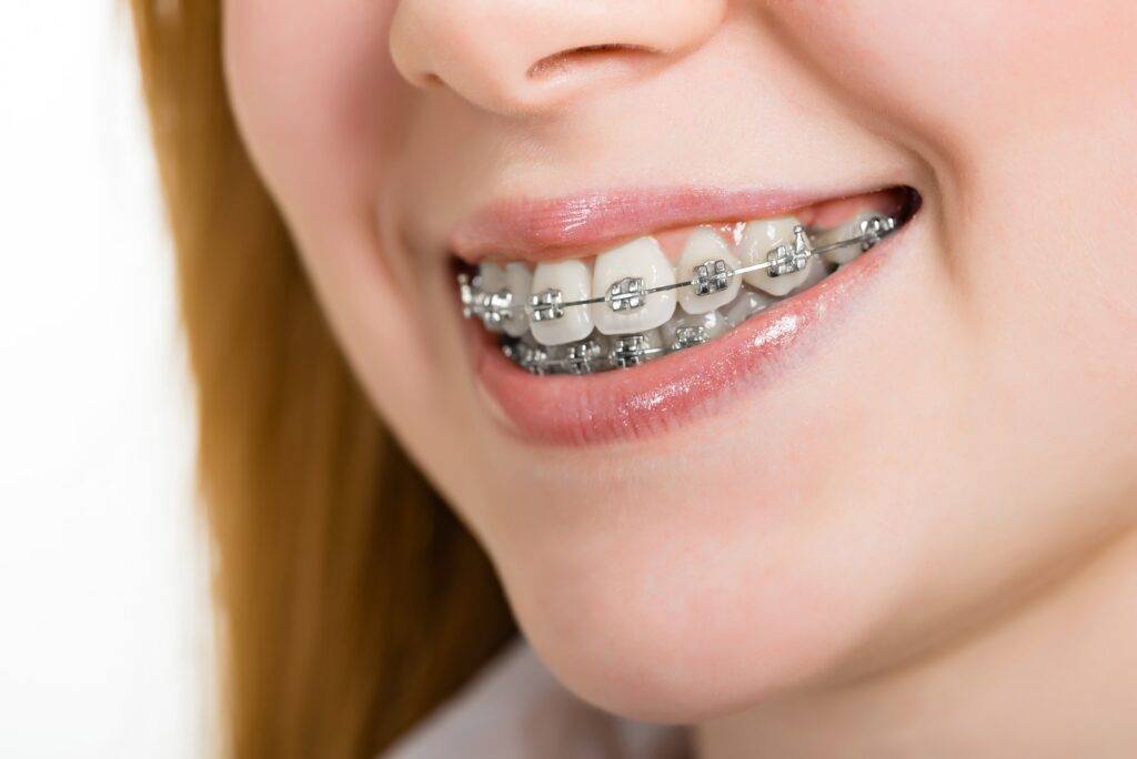 Types Of Materials Used In Braces